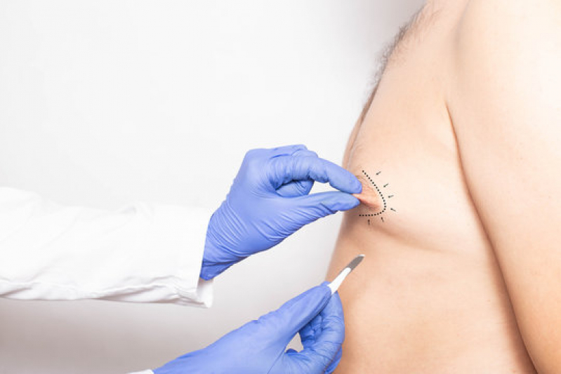 cirurgia-das-mamas-em-homens-orcar